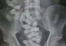 Fiumicino, atterra con 100 ovuli di eroina in corpo