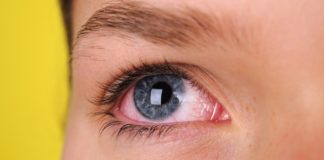 Covid-19: tra i sintomi, in alcuni rari casi, anche congiuntivite e occhi rossi.